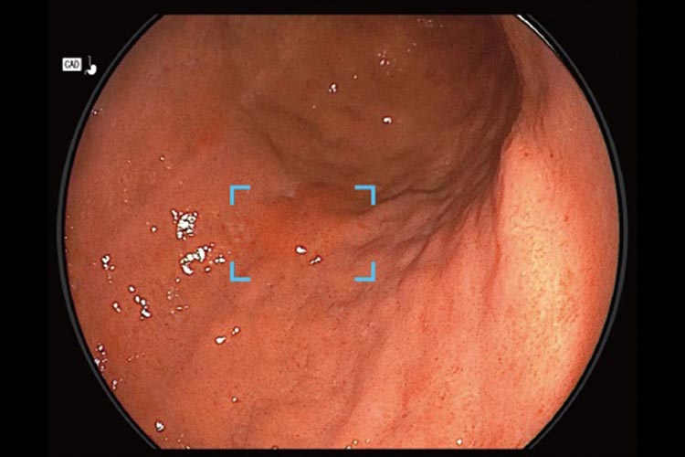 胃カメラの撮影写真